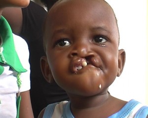 Enfant avec "bec de lièvre"/Infobascongo
